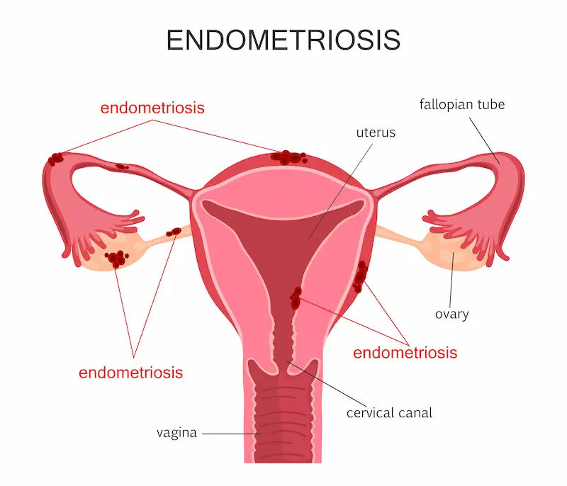Endometriosis Diagnosis and Treatment A Comprehensive Guide